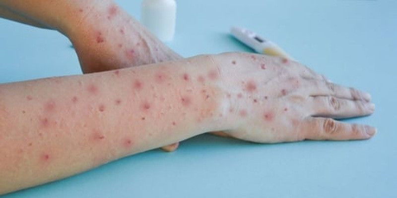 Waspada! Cacar Monyet atau Mpox Mulai Menyebar di DKI Jakarta